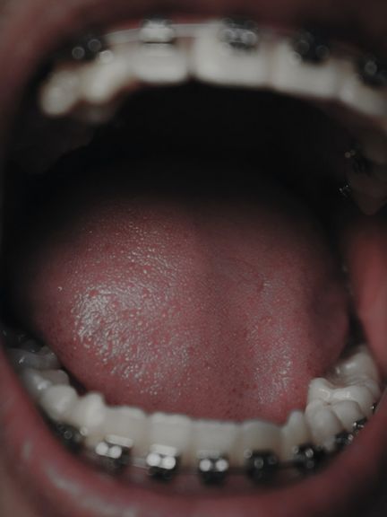 Zunge offener Mund Zahnspange leibniz Magazin 